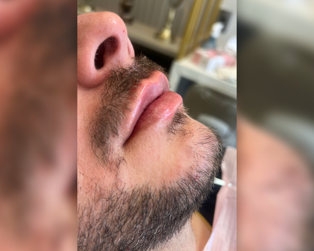 Botox
