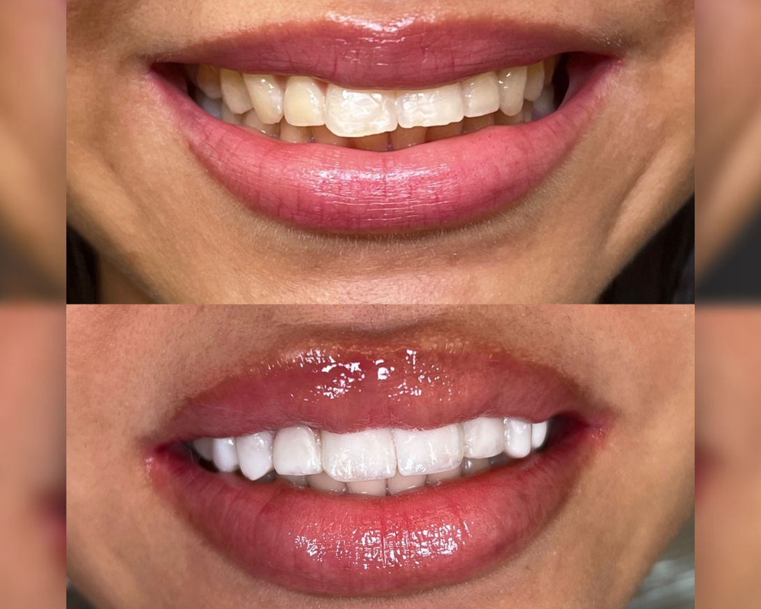 Clareamento dental